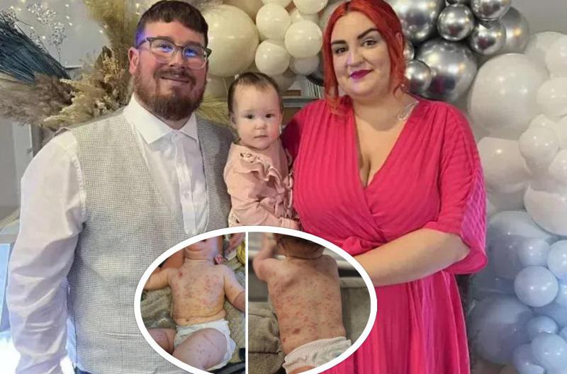 მშობლები ვერ ახერხებენ შვილთან ჩახუტებას, რადგან ამან ბავშვში შეიძლება მძიმე ალერგია გამოიწვიოს - ინგლისელი გოგონა იშვიათი დიაგნოზით