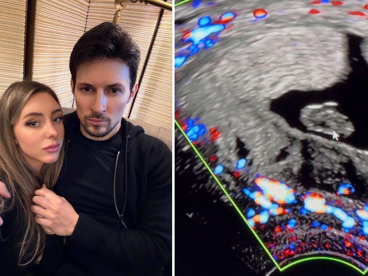 "ტელეგრამის" დამფუძნებელი ამბობს, რომ მისი დაკავების შემდეგ, მისმა მეგობარმა ქალმა ბავშვი დაკარგა - "ბევრ სირთულეს გავუმკლავდით... მაგრამ ჩვენი ბავშვისთვის ეს მეტისმეტი აღმოჩნდა"