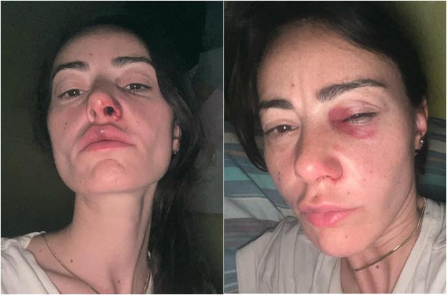 "სპეცრაზმელებს შორის მოვხდი... კითხვებზე ვუპასუხებდი, როდესაც ერთ-ერთმა თავში ორჯერ მოულოდნელად ჩამარტყა, ისეთი ძალით, ცხვირიდან სისხლი წამსკდა" -  რას ჰყვება აქციაზე  ნაცემი ბალერინა?