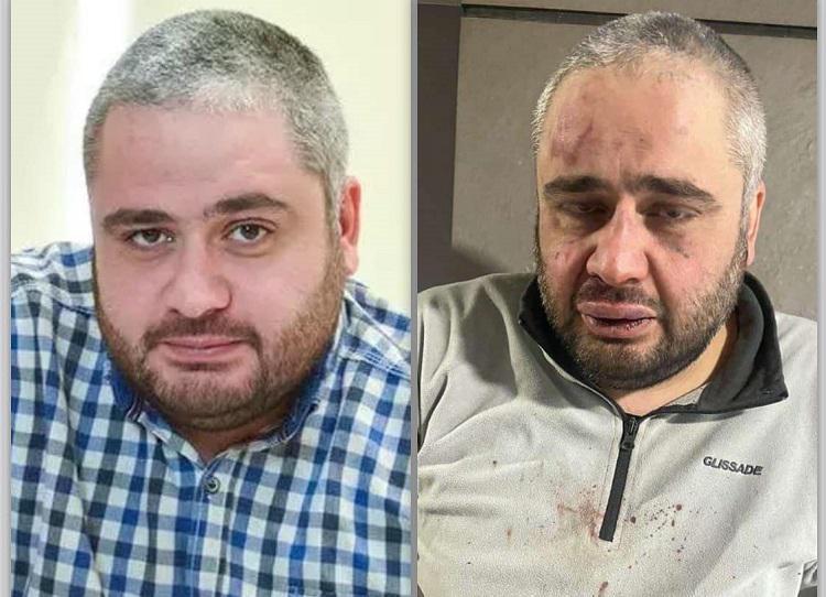 “ასჯერ მეტად სცემეს, რაც გაიგეს რომ ექიმი იყო: გონების დაკარგვა, მოჰპარეს ჯვარი, მობილური და მანქანის გასაღები“ - რა ხდება ცნობილი აქციაზე მყოფი ცნობილი ტრავმატოლოგის შესახებ