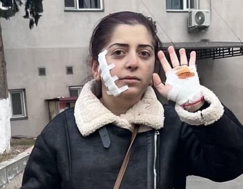 "იმაზე მეტად ვერ შემაშინებენ, ვიდრე რუსეთში გაღვიძების მეშინია" - რას წერს ქალი, რომელსაც გუშინ სამართებლით სახეზე ჭრილობა უცნობმა პირმა მიაყენა