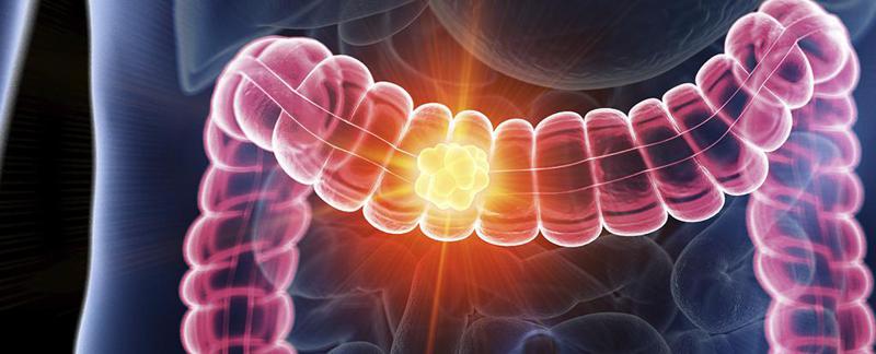 ახალგაზრდებში ნაწლავის კიბოს შემთხვევის საგანგაშო ზრდას ერთ-ერთ ბაქტერიას მიაწერენ - რა დაასკვნეს ოქსფორდისა და კემბრიჯის უნივერსიტეტების მეცნიერებმა