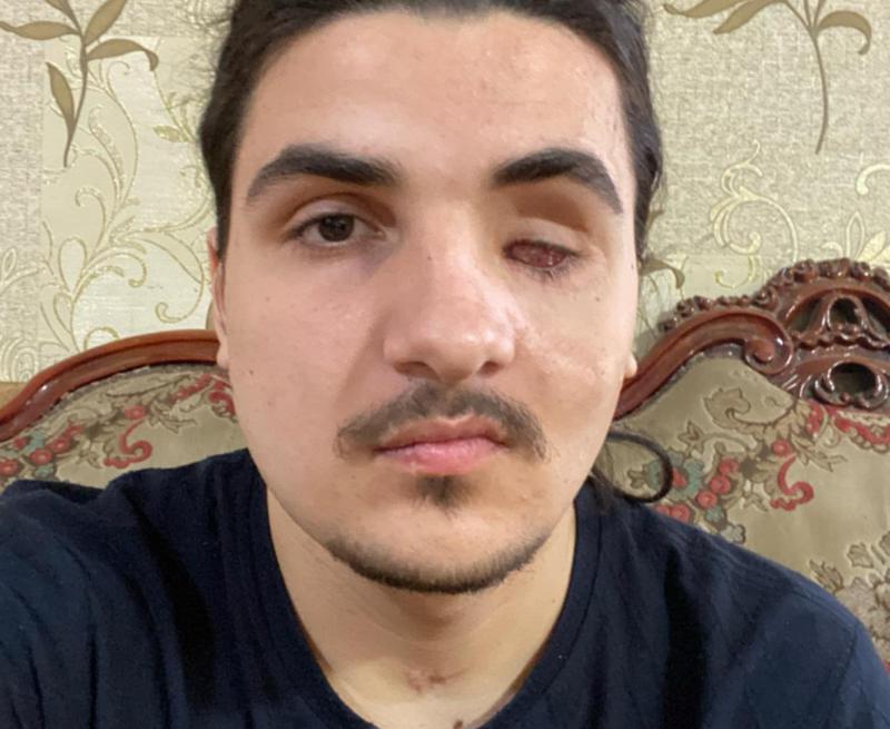 17 წლის იაკობს, რომელიც ავარიის შედეგად მძიმედ დაშავდა, დახმარება ესაჭიროება