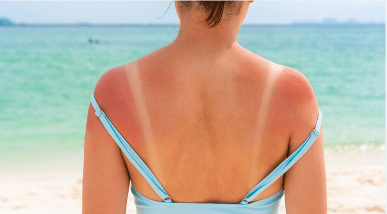 უსაფრთხო რუჯი არ არსებობს - რა რისკებს უქმნის ულტრაიისფერი სხივები კანს?