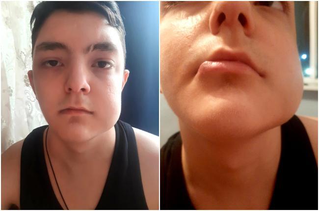 აფხაზეთიდან დევნილი, 15 წლის ბიჭი გამოჯანმრთელებისთვის იბრძვის - ალექსანდრეს ამ ბრძოლაში გამარჯვებისთვის ჩვენი დახმარება სჭირდება