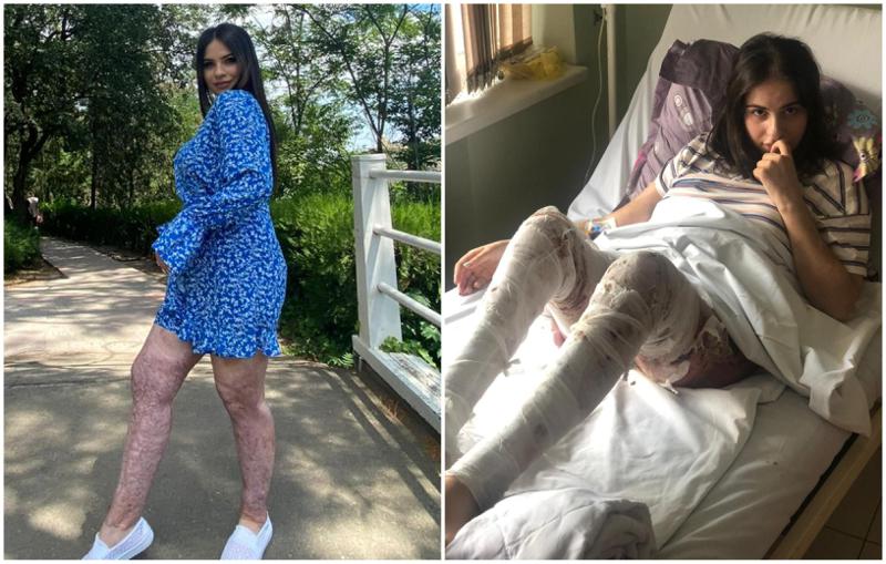 "მას შემდეგ, რაც ცოცხლად დავიწვი, ღმერთის გარდა აღარავის მეშინია... დამნაშავეს 5 წელი მოაკლეს პატიმრობის" - როგორ ცხოვრობს გოგონა, რომელიც 5 წლის წინ შეყვარებულმა სასიკვდილოდ გაიმეტა