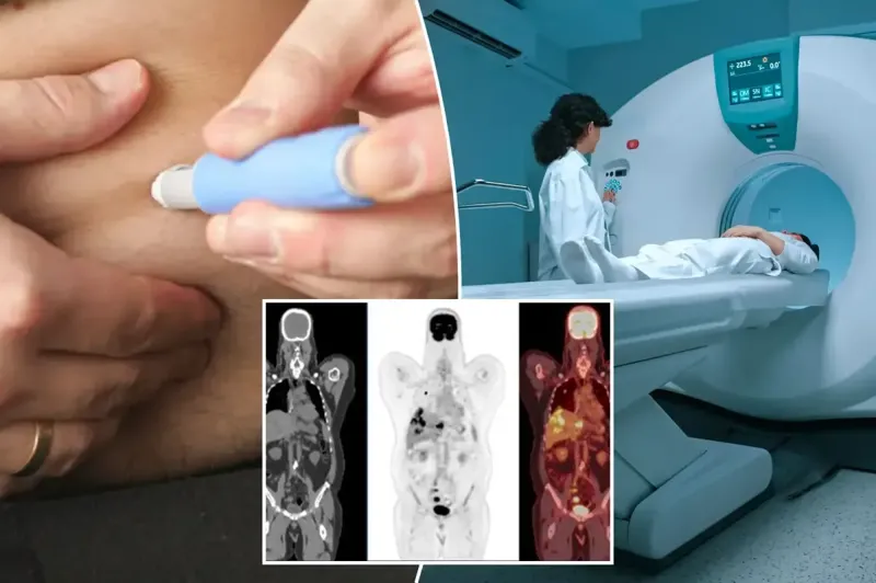 პოპულარულმა გასახდომმა საშუალებამ შესაძლოა, ტომოგრაფიის დროს სიმსივნის ნიშნები შენიღბოს - "ოზემპიკი" და კიდევ ორი მედიკამენტი ექიმებში შეშფოთებას იწვევს