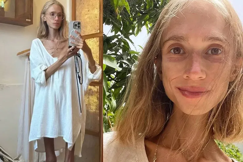 საბედისწერო დიეტა: 27 წლის პოლონელი გოგონა, რომელიც წლების განმავლობაში ხილის დიეტას იცავდა, კუნძულ ბალიზე გარდაცვლილი ნახეს