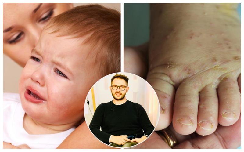 "მუნი არის დაავადება, რომელიც არ უნდა არსებობდეს XXI საუკუნეში.... ჩვენს ქვეყანაში ჯერ კიდევ გვხვდება მუნი და ეს არ ნიშნავს, რომ ადამიანები "არასუფთები" არიან" - ლაშა უჩავა