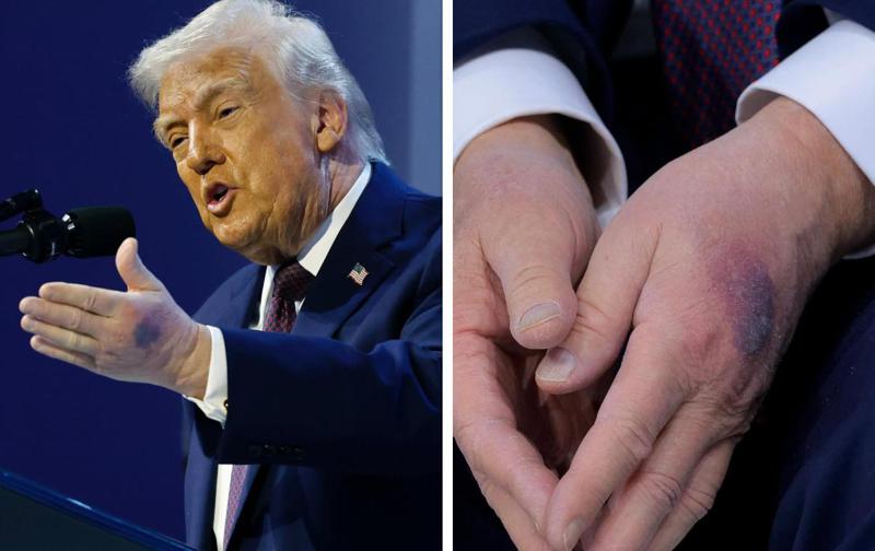 რა დაემართა ტრამპს ხელებზე და რატომ აქვს სისხლჩაქცევები - "ექიმმა მითხრა, რომ..."