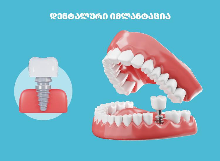 კბილის იმპლანტაცია - სრული გზამკვლევი