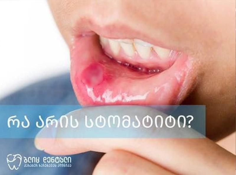 რა არის სტომატიტი?