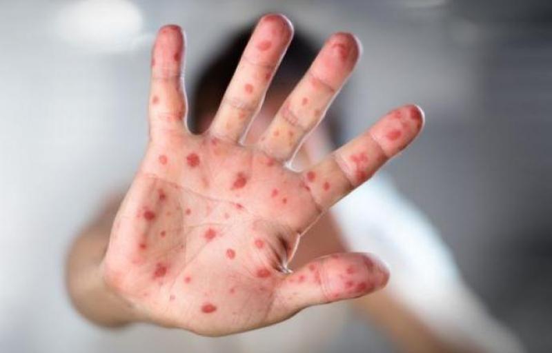 სამოაში წითელას ვირუსს 22 ადამიანი ემსხვერპლა - გარდაცვლილთა უმრავლესობა 5 წლამდე ბავშვია