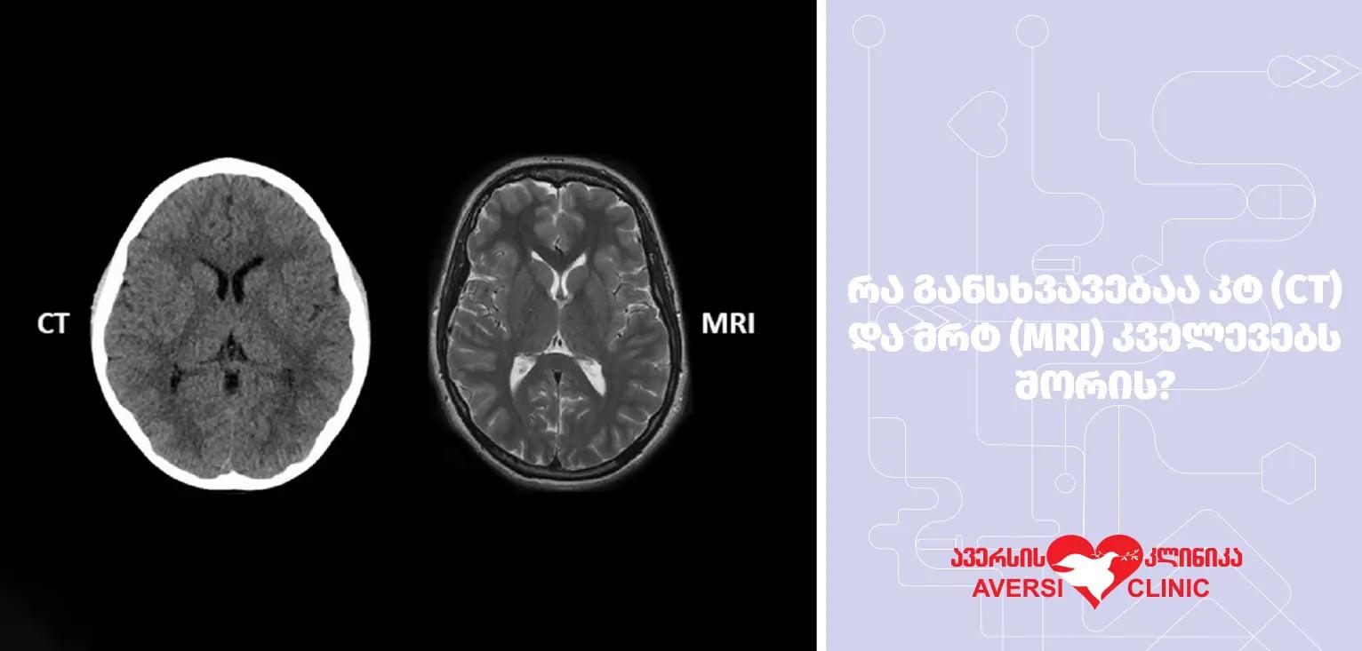 რა განსხვავებაა კტ (CT) და მრტ (MRI) კვლევებს შორის?